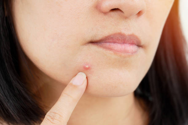 6 Natural Home Remedies to Get Rid of Pimples