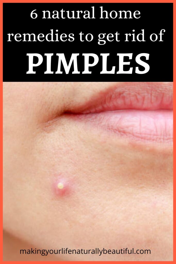 Home remedies to treat pimples